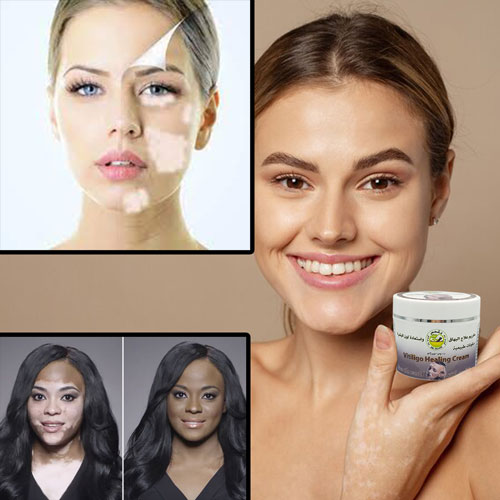 Vitiligo and White Spot Cream