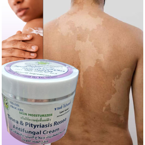 Antifungal Cream for Tinea & Pityriasis Rosea